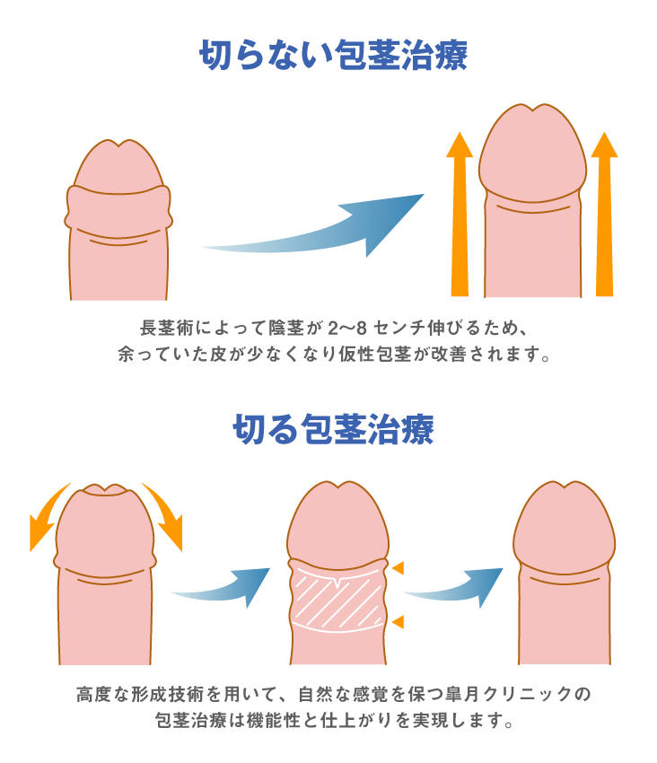 カントン包茎（剥けた皮による締め付け）